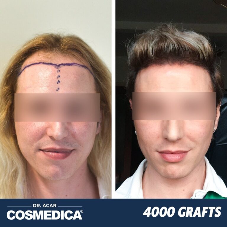 Hair Transplant in Turkey with 4000 Grafts