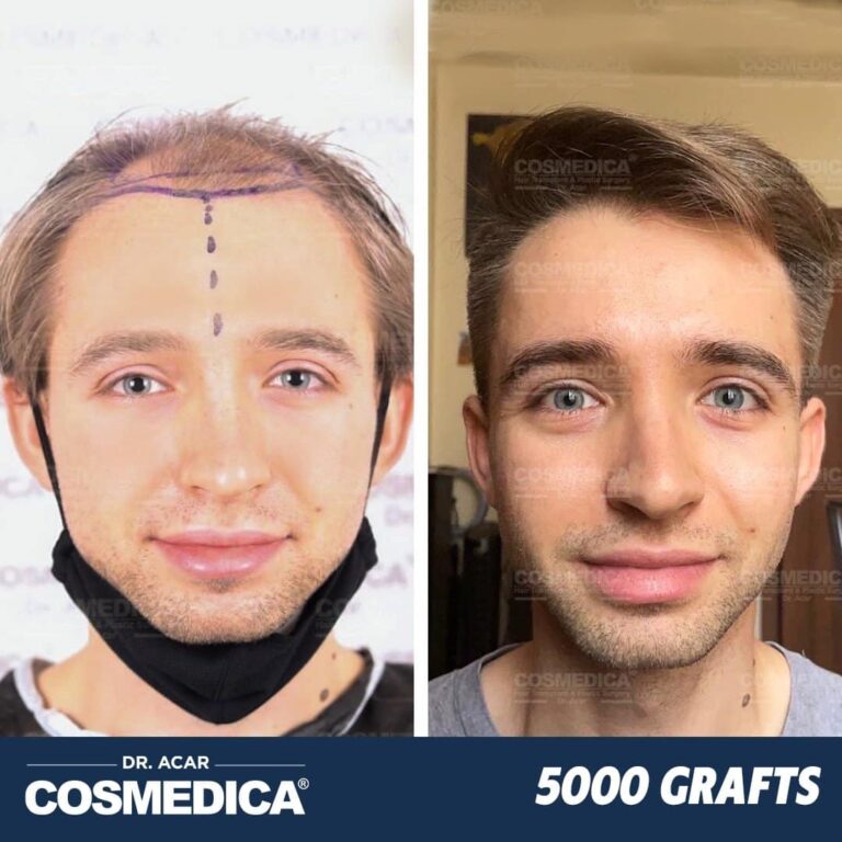 Hair Transplant in Turkey with 5000 Grafts