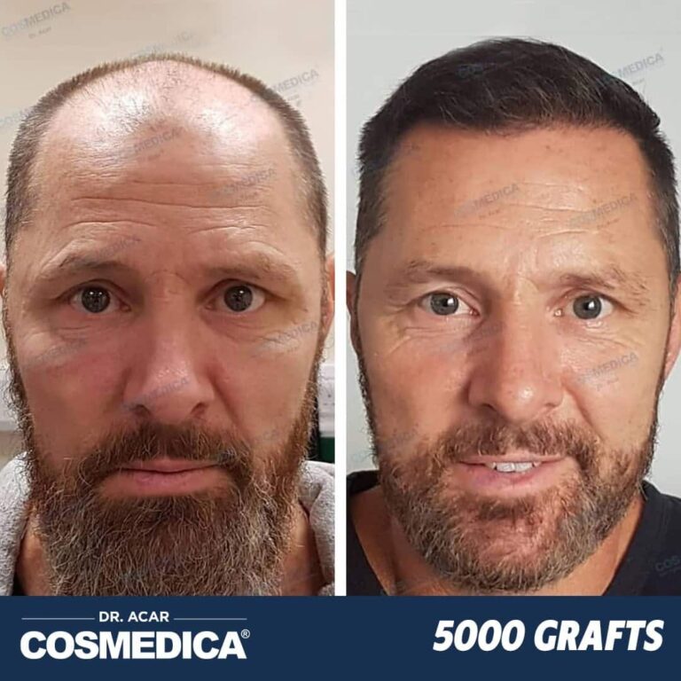 Hair Transplant in Turkey with 5000 Grafts