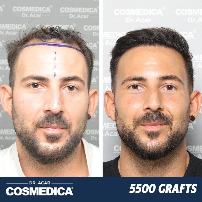 Hair Transplant in Turkey with 5500 Grafts